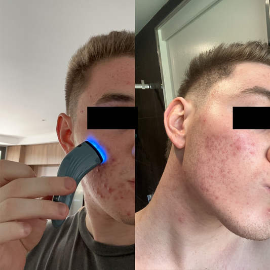Clear Me: 3-Minute Spot Treatment